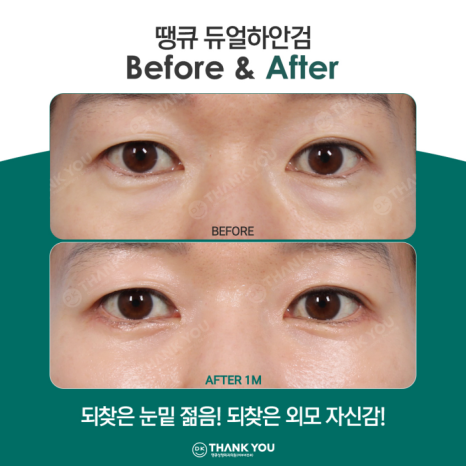 If You Want a Satisfying Difference Before and After Lower Blepharoplasty?! Thank You Dual Lower Blepharoplasty image 9