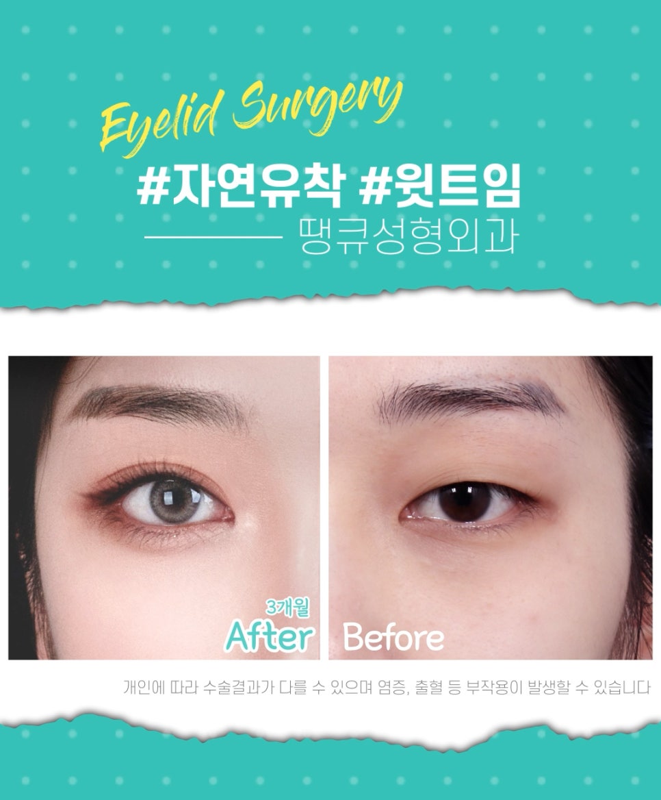 쌍수 윗트임 전후, 내게 맞춘 쌍트 수술로 화려하게 관련 이미지 3