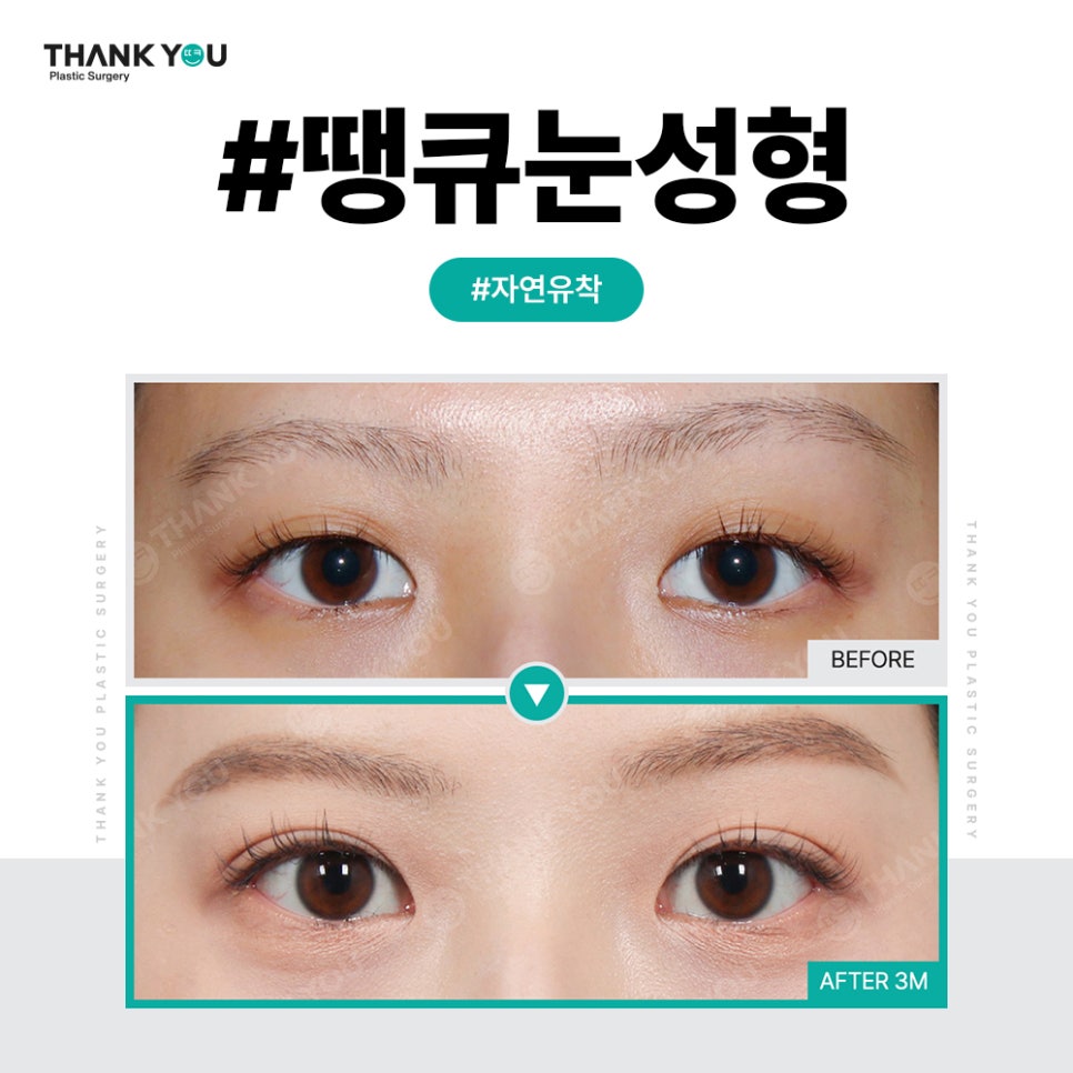 쌍꺼풀 라인 종류, 내게 맞는 쌍수랑 트임은?(인라인) 관련 이미지 8