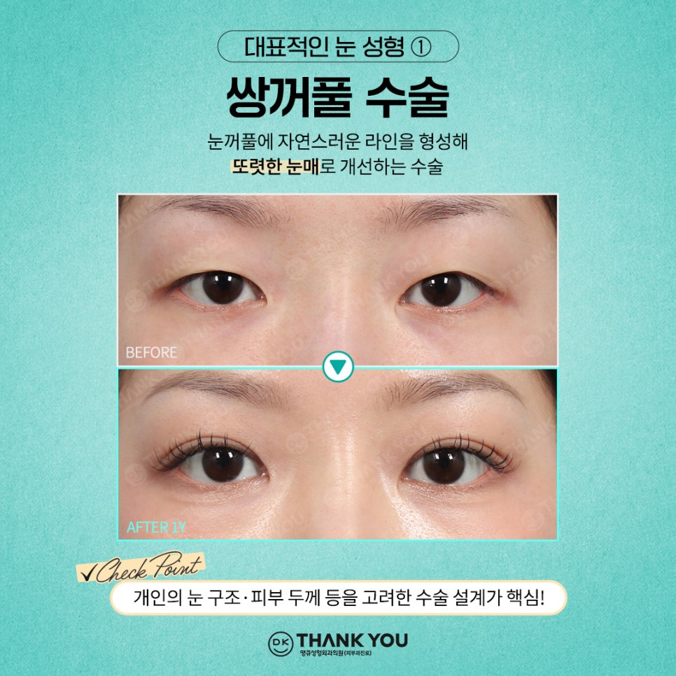 첫눈성형 후기 좋은 땡큐에서 만드는 예쁜 눈매💚 관련 이미지 2