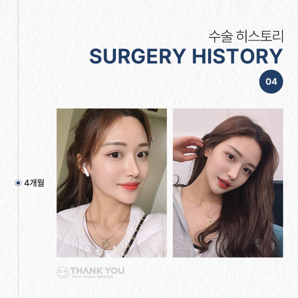 눈코성형 같이 하고싶다면? (자연유착 윗트임+콧불축소) 관련 이미지 8