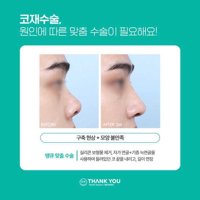 코재수술병원에서 알려주는 재수술하게 되는 이유! 관련 이미지 7
