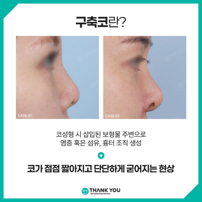 구축코재수술, 땡큐에서 받아야 하는 이유는?! 관련 이미지 2