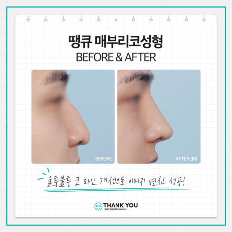 매부리코개선 맞춤 디자인으로 원하던 워너비 코 완성! 관련 이미지 4