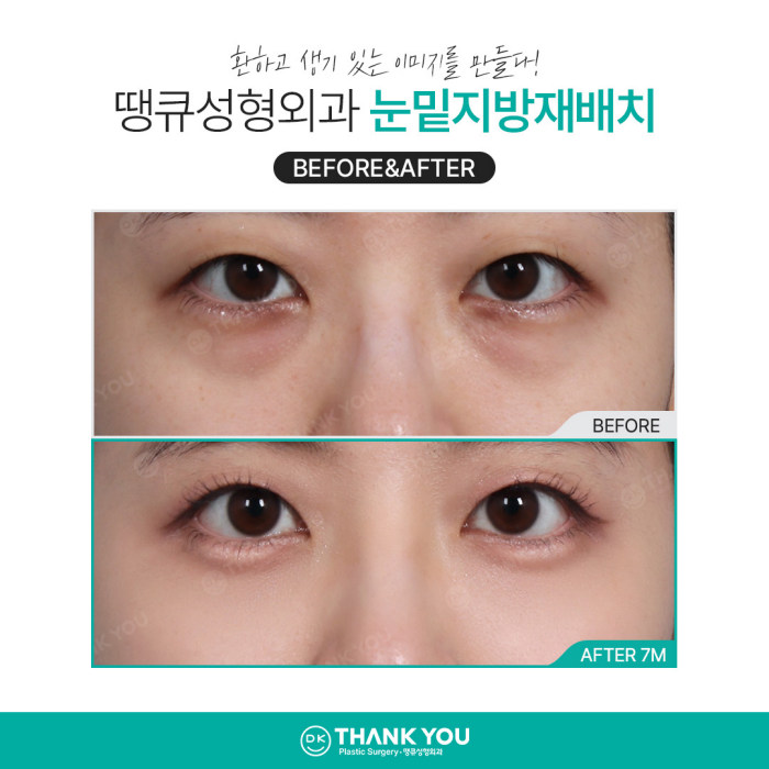눈밑지방재배치병원에서 알려주는 수술이 필요한 케이스 관련 이미지 9