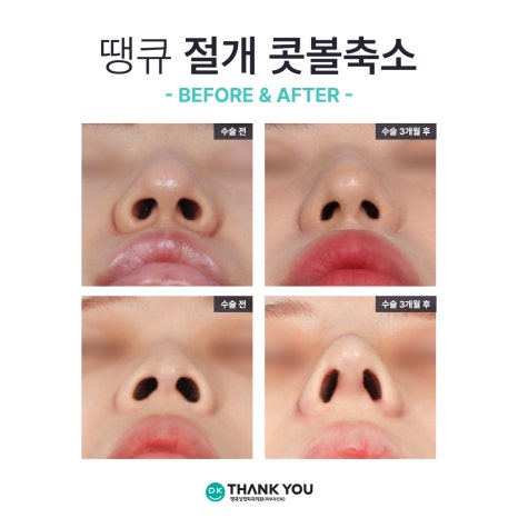 콧볼성형 찾는다면 여기! 땡큐 콧볼축소로 세련된 이미지 완성하기! 관련 이미지 15