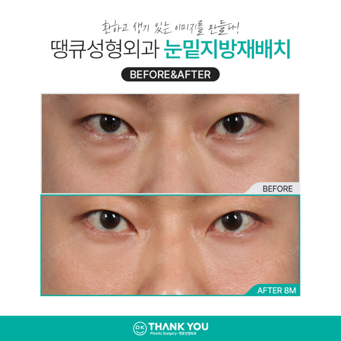 눈밑지방재배치병원에서 알려주는 수술이 필요한 케이스 관련 이미지 8