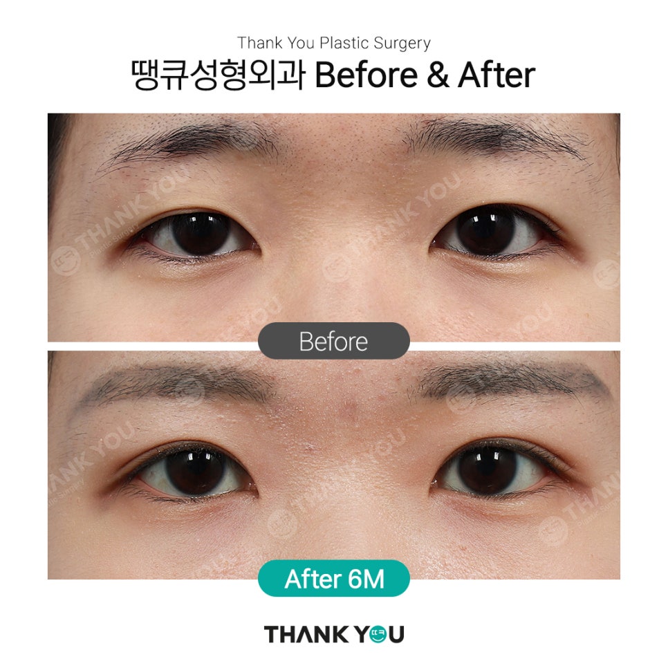 쌍꺼풀 라인 종류, 인아웃+세미아웃라인 Before After 관련 이미지 2