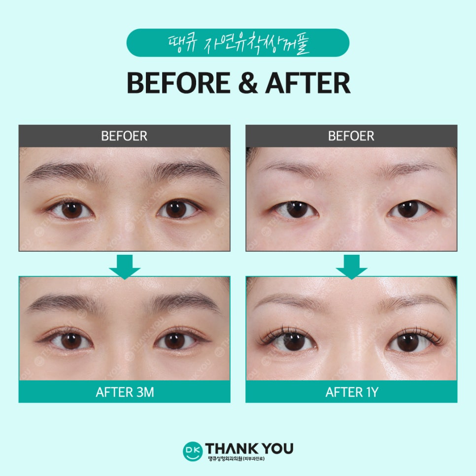 Natural adhesion double eyelid review: Beautiful, naturally-looking lines completed at Thank You! image 7