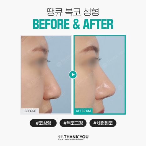 복코성형, 꼭 코뼈절골을 해야할까요? 관련 이미지 8