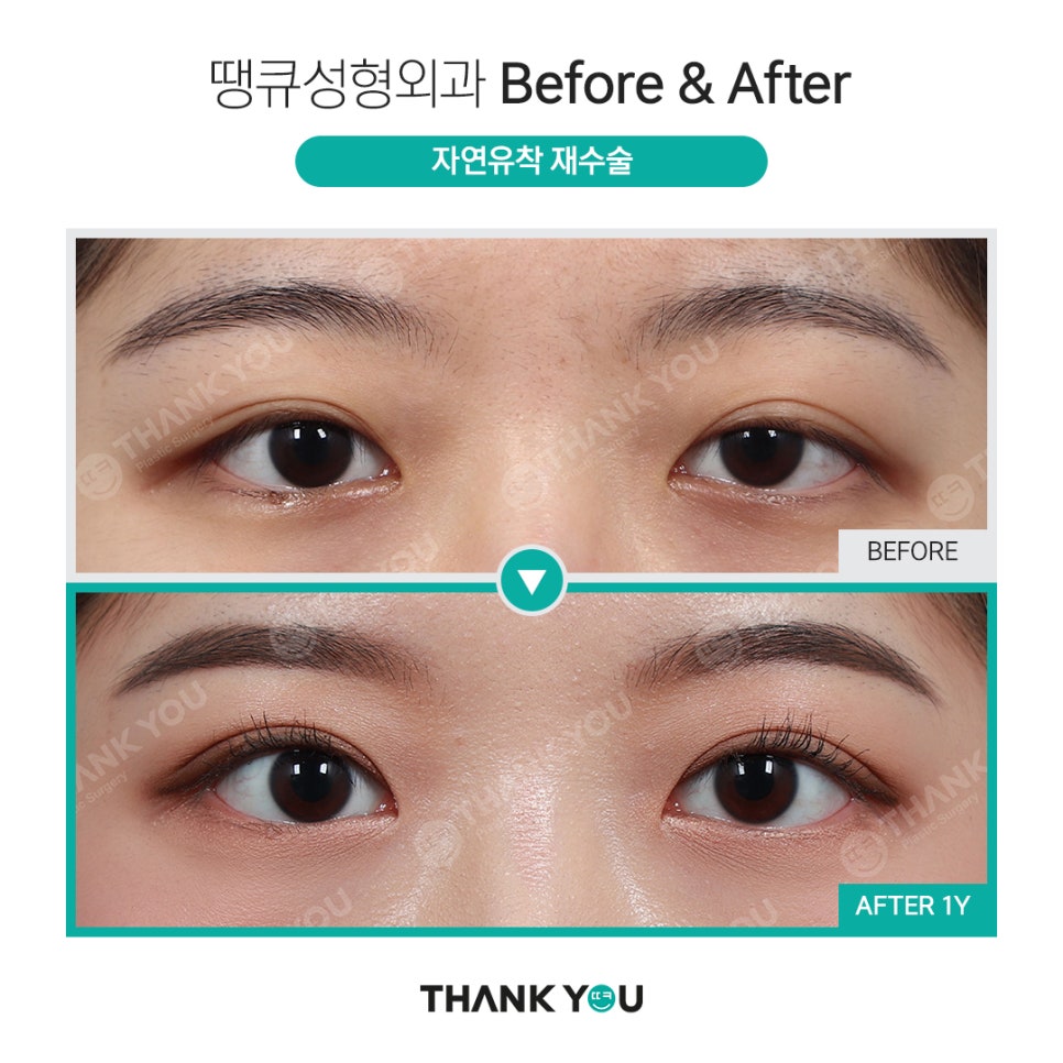 실패한 쌍수(겹주름) 눈성형 재수술 전후 사진 Point✨ 관련 이미지 7