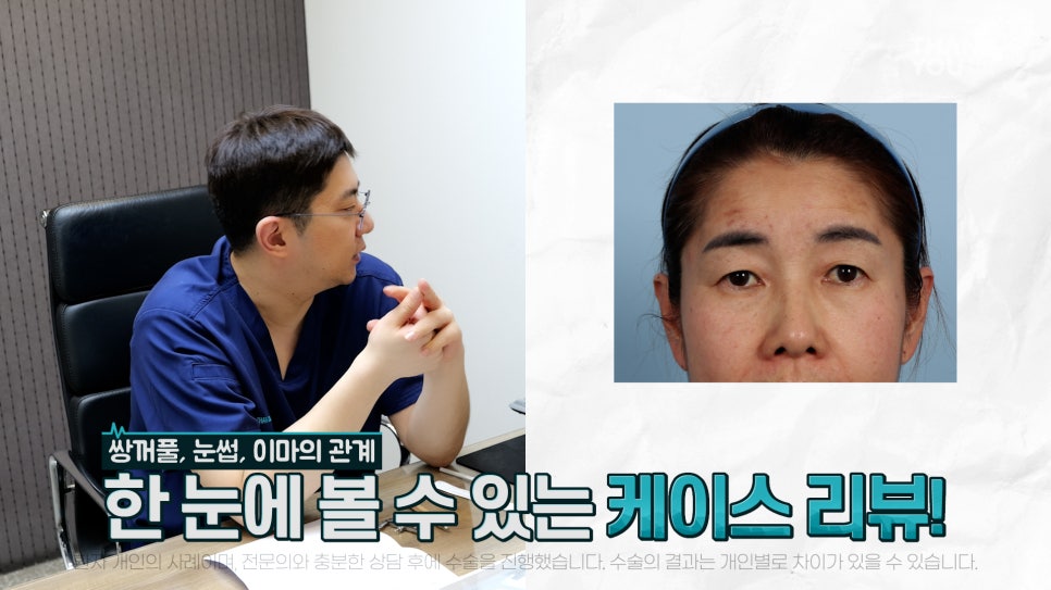 중년눈성형 전후& 이마거상+눈썹하거상+쌍수로 젊어지기 관련 이미지 3