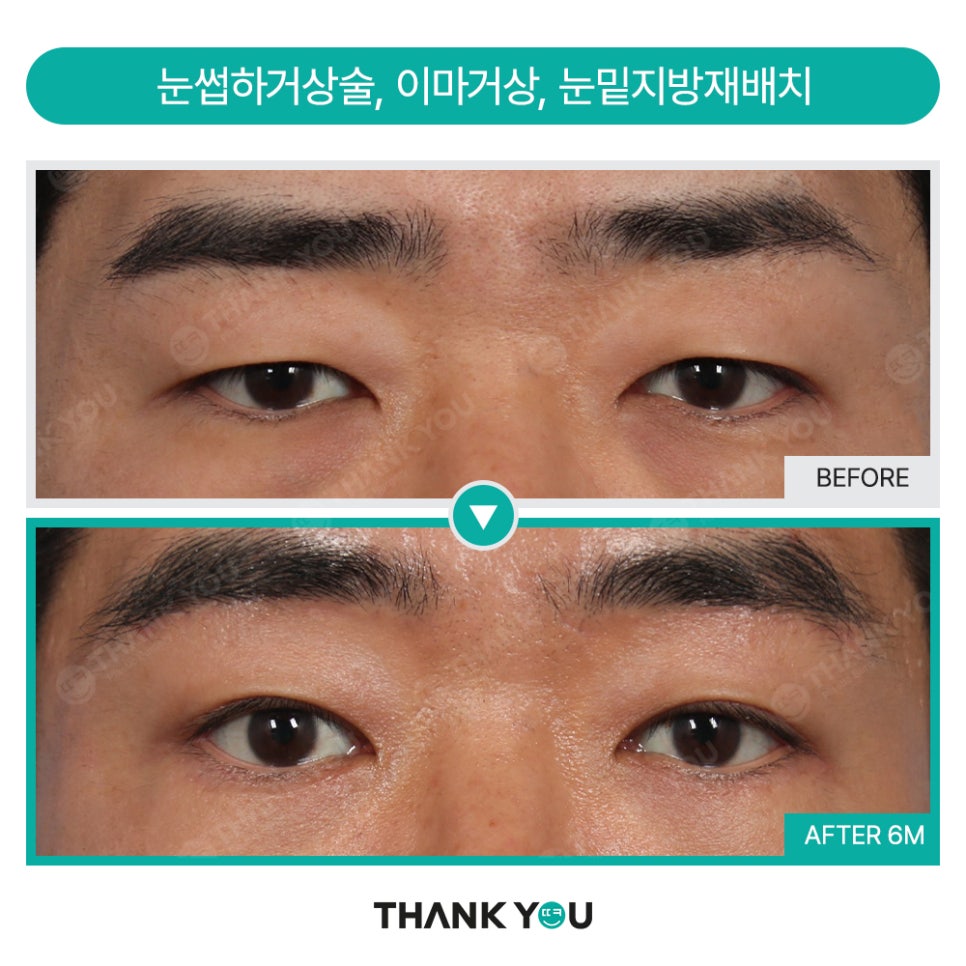 눈밑지방재배치 함께 필요한 미세 지방이식?(땡큐 나노펫) 관련 이미지 9