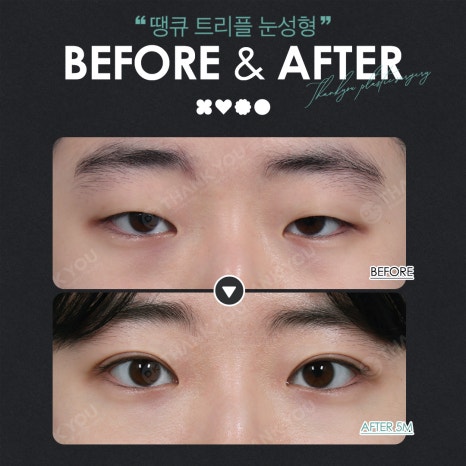 Thank You’s Exam Taker Event at a Great Place for Eye Surgery! ✨Triple Eye Surgery✨ image 12