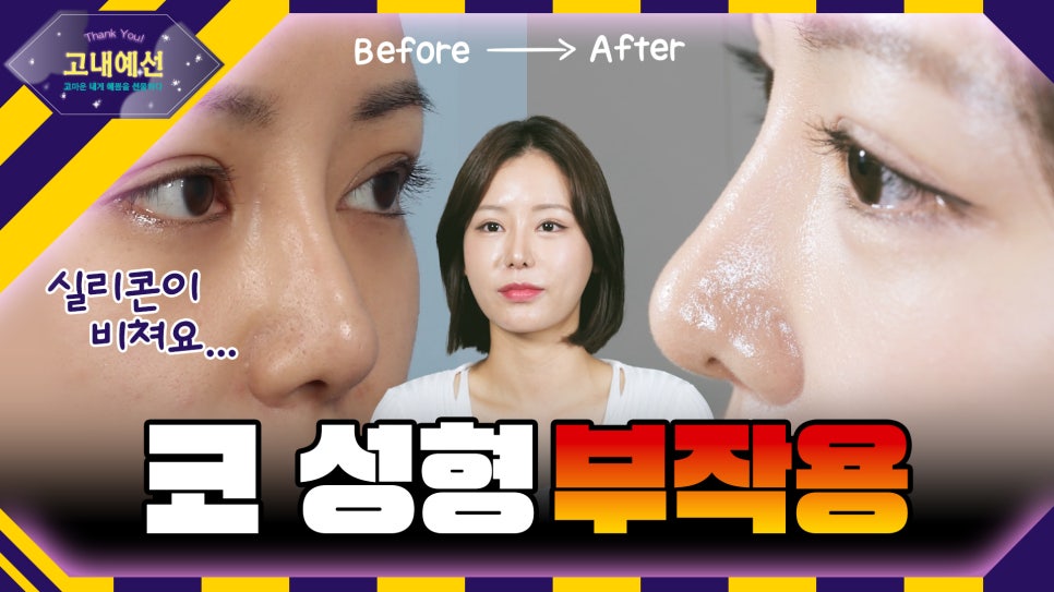 코성형 실리콘 비침, 코낮추기 재수술로 매끈하게 관련 이미지 1