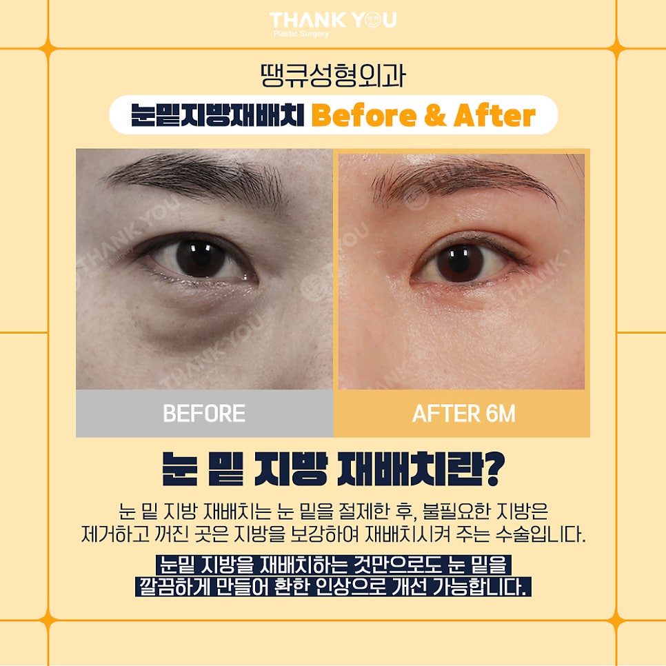 땡큐성형외과 이호준 원장님, 눈밑지방재배치 외고정vs내고정 차이점 관련 이미지 5