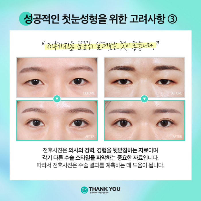 첫눈성형 성공을 위해, 눈수술 잘하는 곳 찾는 방법은? 관련 이미지 6