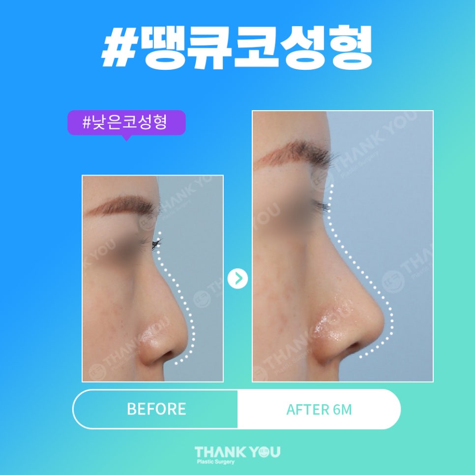 코성형 전후, 코모양 신논현역 성형외과에서 체크 관련 이미지 10