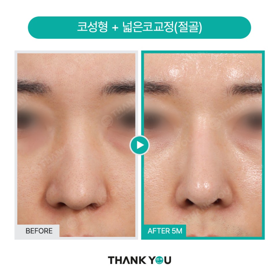 남자코성형 (휜코, 매부리코 등) 기능코성형 필요! [ft.코수술전후] 관련 이미지 20