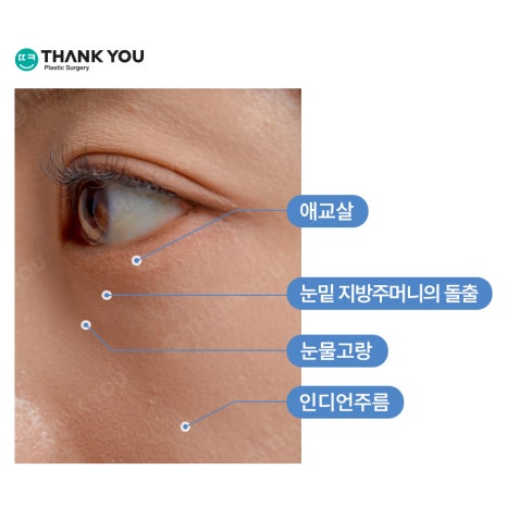 눈밑수술, 눈밑지방이식도 가능한가요? 관련 이미지 4