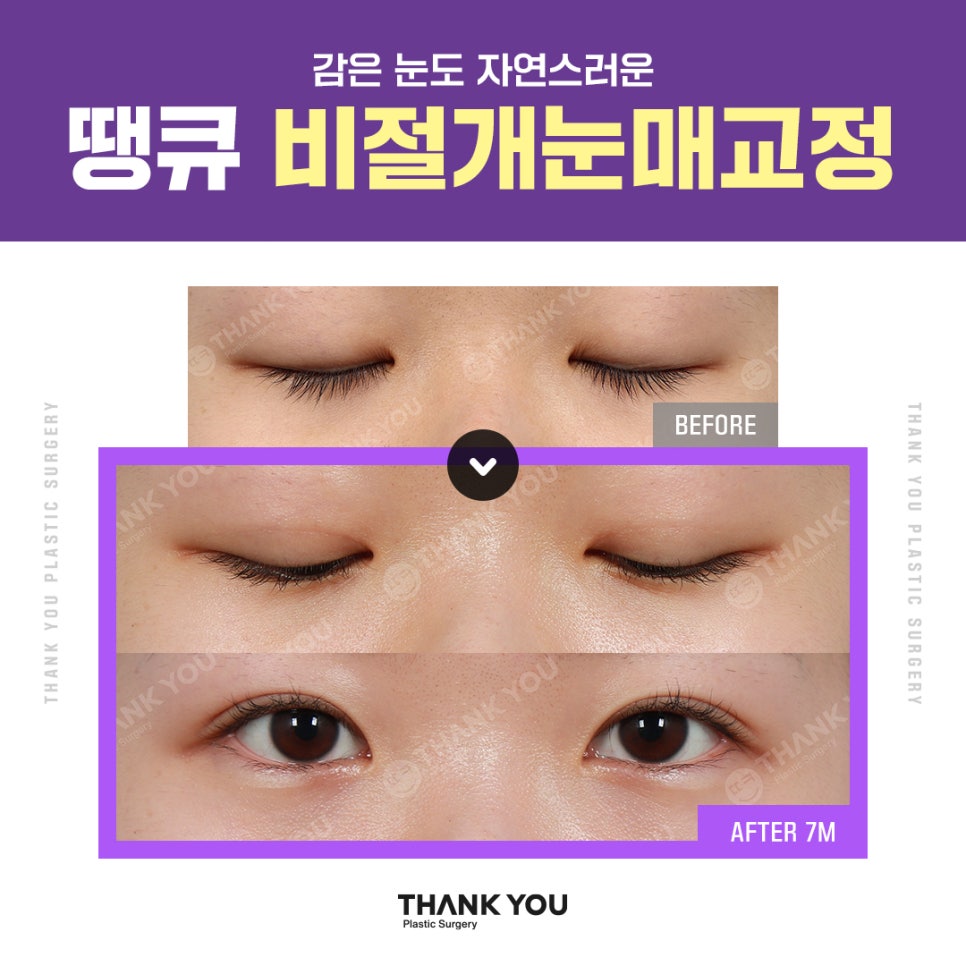 눈매교정 전후? 수술 전후사진으로 체크해요 관련 이미지 2
