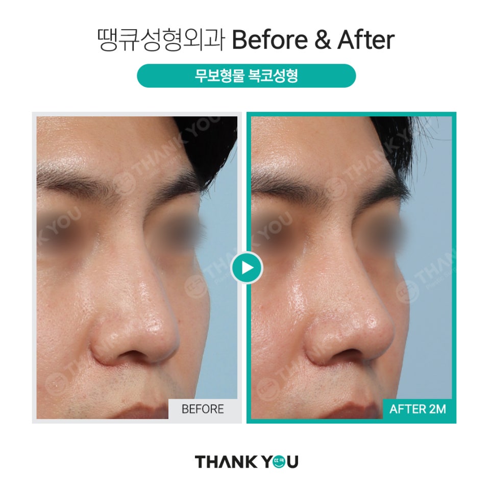 휜코 성형, 휜코 교정 과연 간단할까?(비포&애프터) 관련 이미지 10