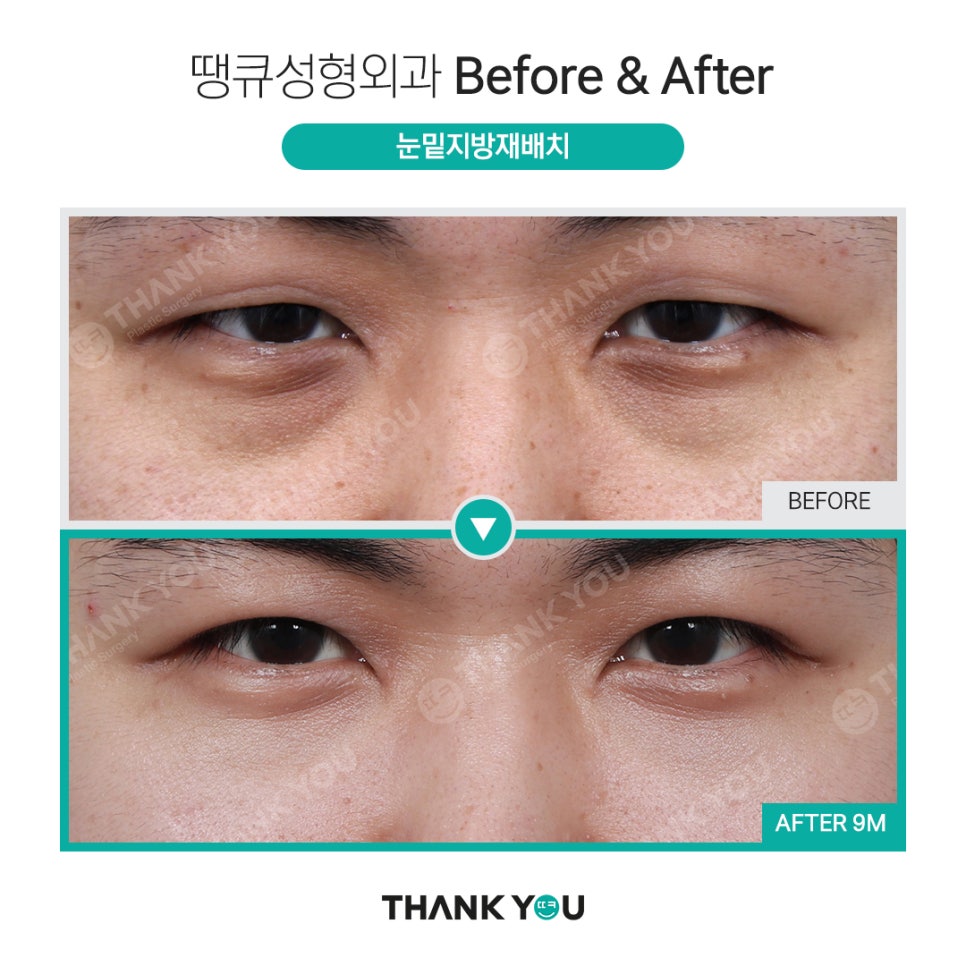 눈밑성형에 격막 강화란 무엇인가요? [눈밑지] 관련 이미지 11