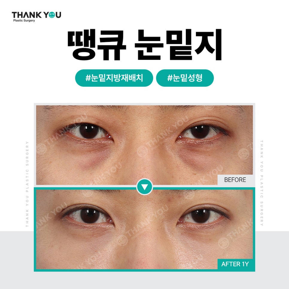 눈밑 불룩, 눈밑지 대신 눈밑지방제거만 단독으로? 관련 이미지 13