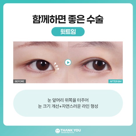 비절개 눈매교정 vs 절개 눈매교정 뭐가 다를까? 관련 이미지 11