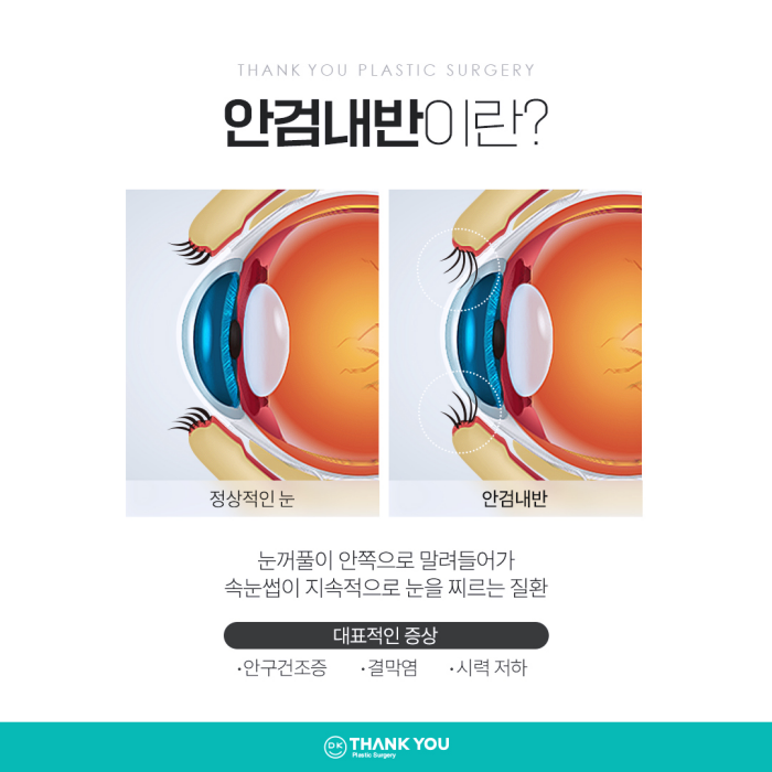 기능눈성형 근본적인 원인을 개선해야 해요! 관련 이미지 4