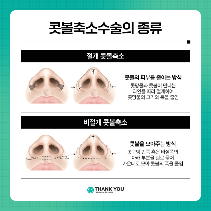 콧볼축소술로 촌스러운 이미지 만드는 콧볼줄이기! 관련 이미지 4
