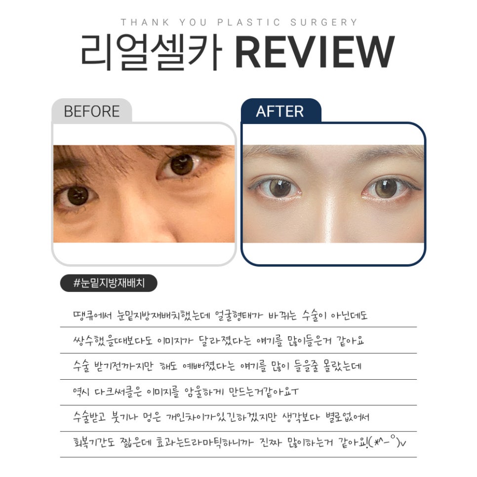 땡큐 다크서클 수술&눈밑지방재배치 리얼셀카  𝐑𝐄𝐕𝐈𝐄𝐖 관련 이미지 3