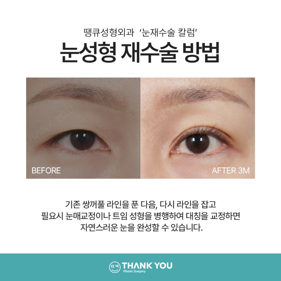눈재수술 실패하지 않으려면? 눈 재수술유형&전후 체크 관련 이미지 5