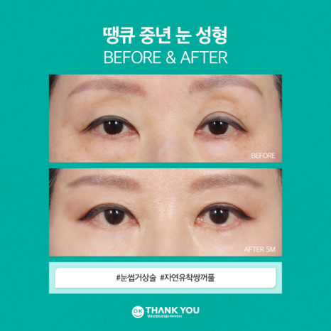 눈썹거상술 & 자연유착쌍꺼풀로 처진 눈꺼풀 효과적으로 개선! 관련 이미지 9