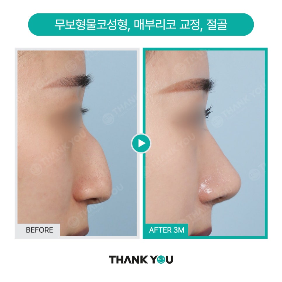이런 코는 무조건 성공?! 코성형 성공 유형 관련 이미지 6