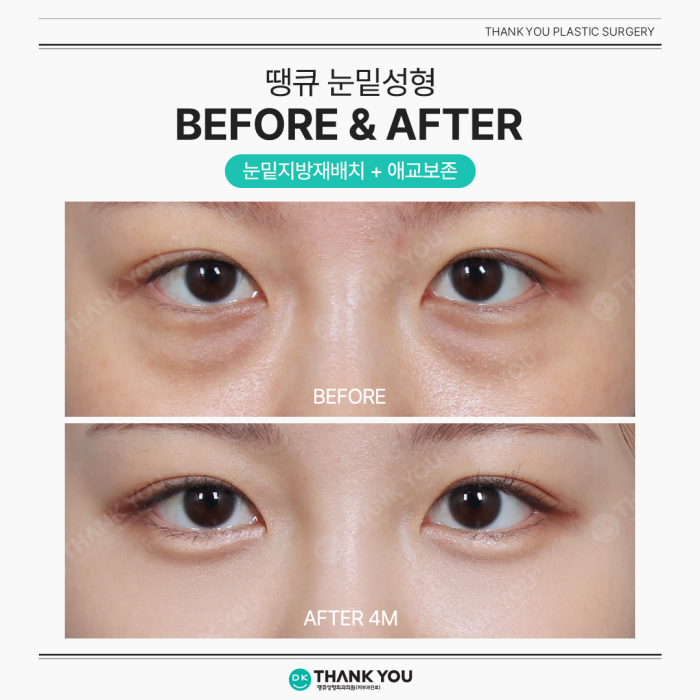 Lower Blepharoplasty and Under-Eye Fat Repositioning: What’s the Difference? image 6