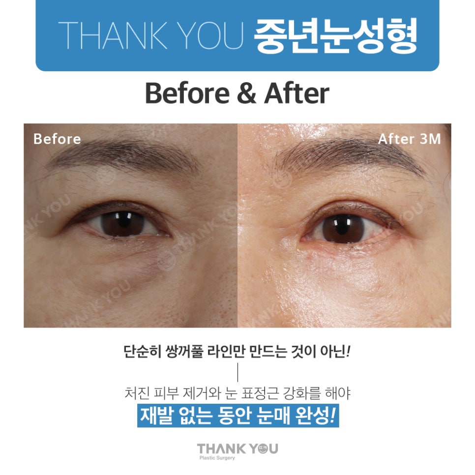 중년눈수술, 50대 60대 눈처짐과 눈꺼풀짓무름 해결법 관련 이미지 8