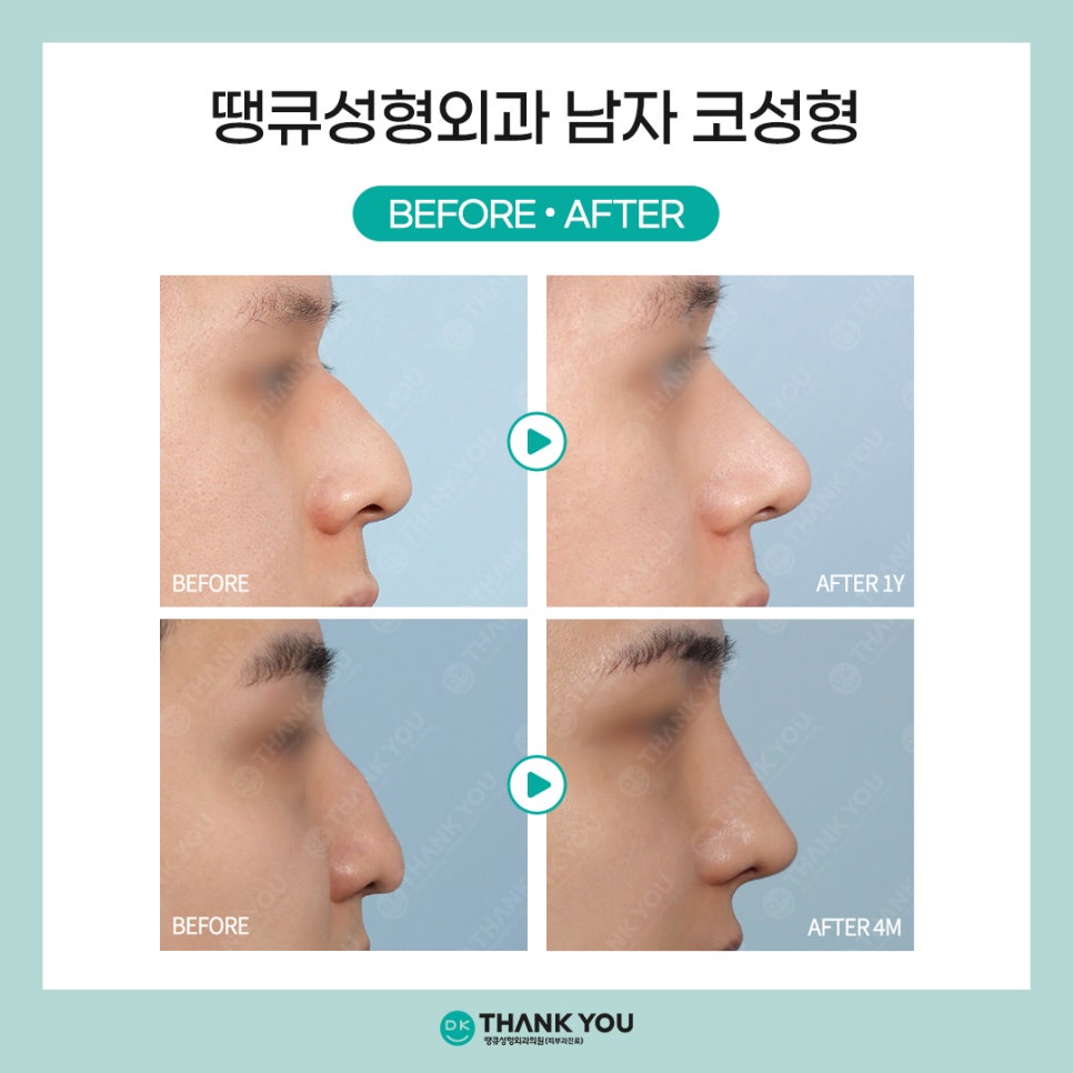 [남자코수술 전후] 코성형외과는 왜 땡큐일까?! 관련 이미지 11