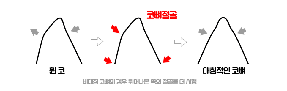 휜코 성형, 휜코 교정 과연 간단할까?(비포&애프터) 관련 이미지 4