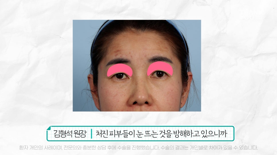 중년눈성형 전후& 이마거상+눈썹하거상+쌍수로 젊어지기 관련 이미지 13