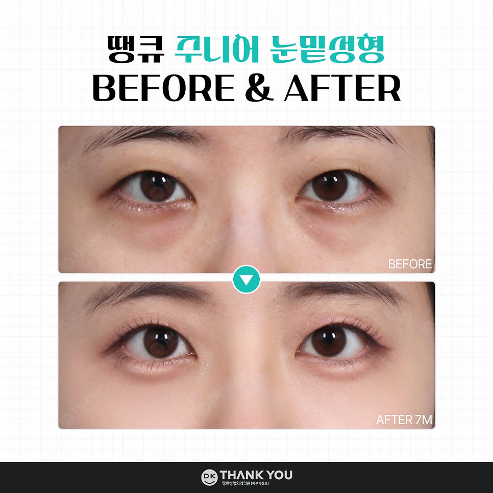 눈밑성형, 연령별로 달라지는 수술법! 무엇이 다를까? 관련 이미지 8