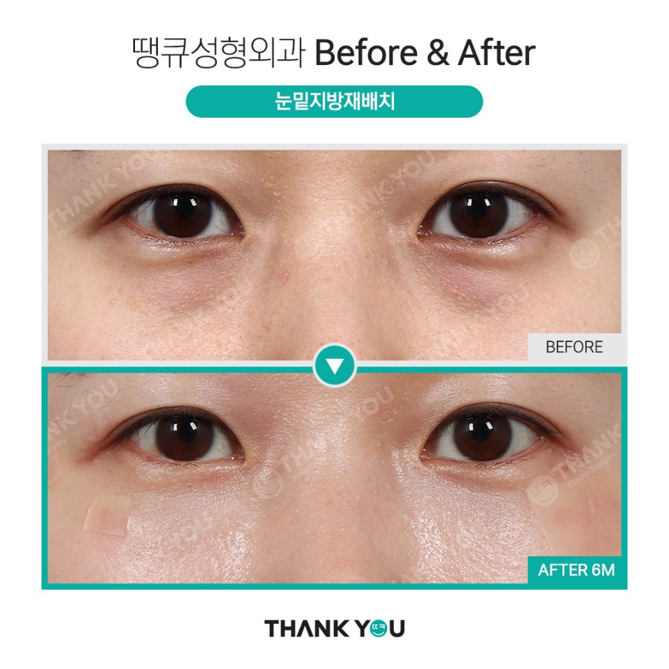 눈밑 필러 넣었는데 눈밑지방재배치 가능할까요? (이호준 칼럼) 관련 이미지 13