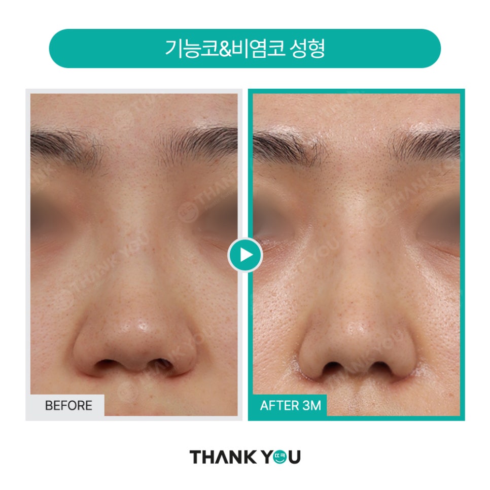 2분만에 막힌 코 뻥 뚫어주는 코블레이션 [ft.비염코성형 전후] 관련 이미지 20