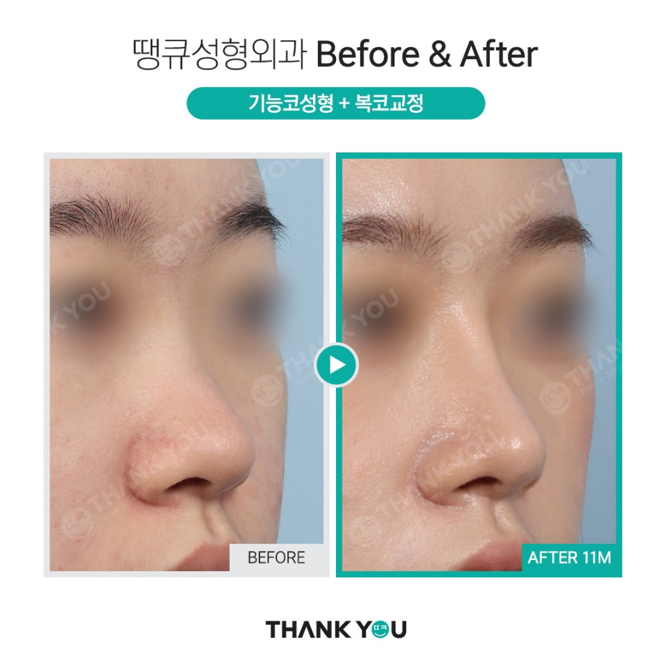 강남 코성형 전후, 코수술 잘하는 곳? 관련 이미지 8