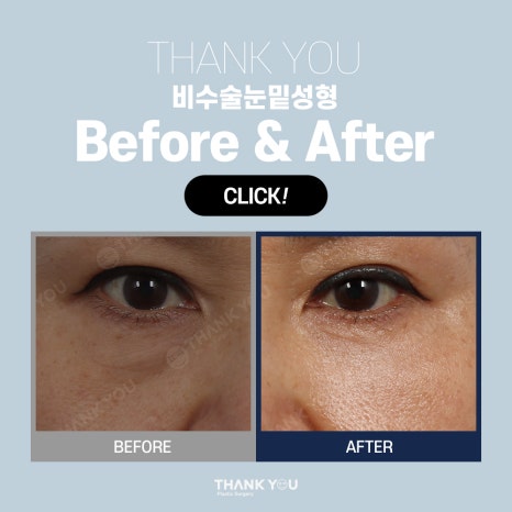 비수술 눈밑성형, 레이저 눈밑지방재배치란? 관련 이미지 10
