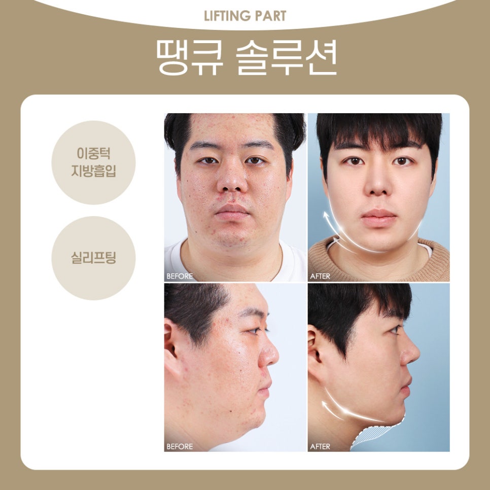 땡큐 맥미남, 뮤지컬배우 남자 복부지방흡입 전후 Check 관련 이미지 2