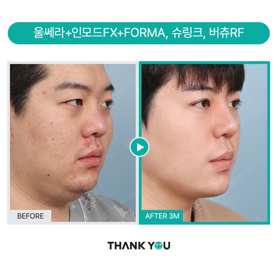 땡큐 맥미남, 뮤지컬배우 남자 복부지방흡입 전후 Check 관련 이미지 16