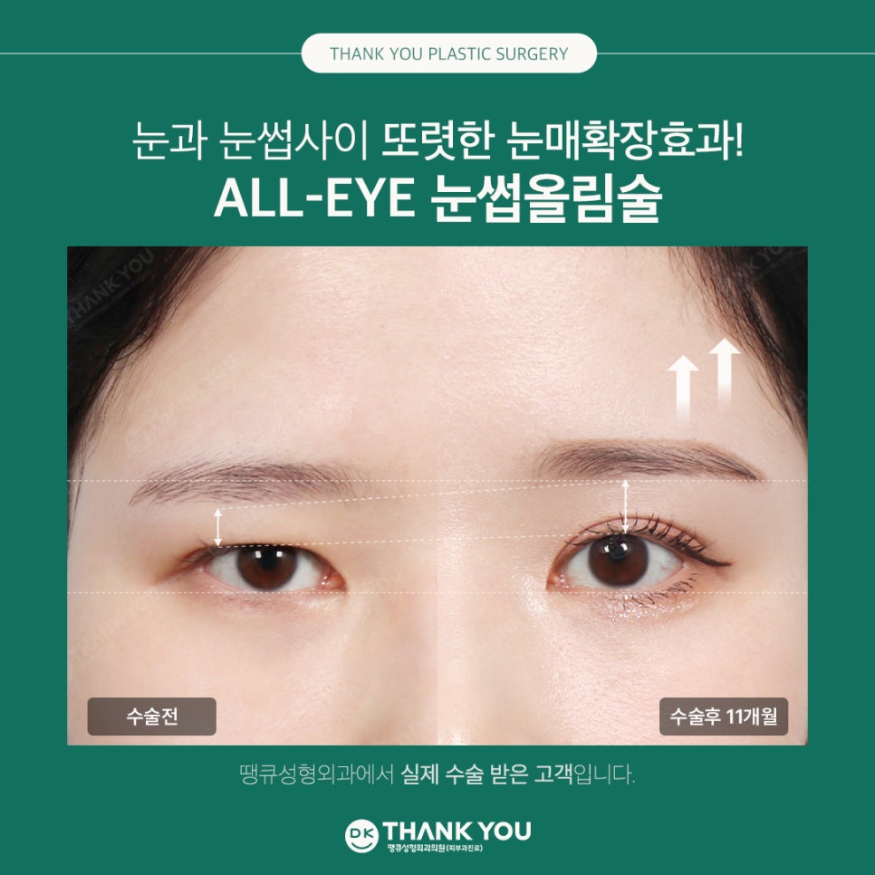 Improving Drooping, Tired-Looking Eyes in One Go with Forehead Lift Surgery! image 3