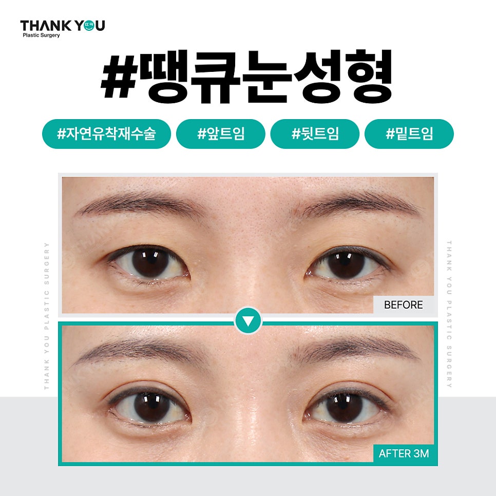 쌍꺼풀 라인 종류, 내게 맞는 쌍수랑 트임은?(인라인) 관련 이미지 3