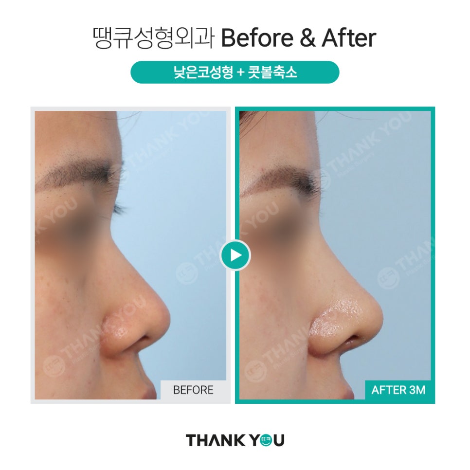 코 성형전, 코필러 꼭 제거해야 하나요? [코 수술전 필독!] 관련 이미지 10